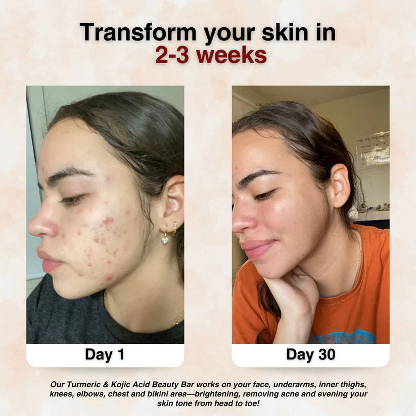 Turmeric & Kojic Acid - Skin Brightening Soap