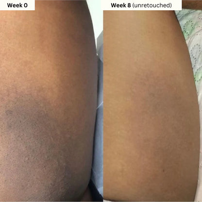 Turmeric & Kojic Acid - Skin Brightening Soap