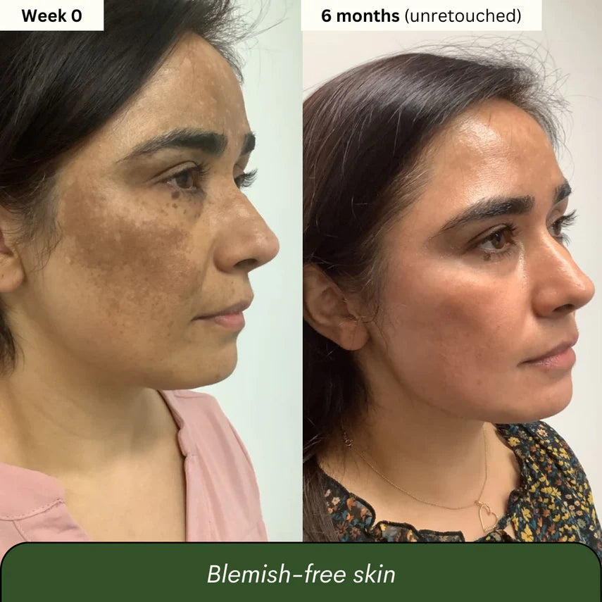 Turmeric & Kojic Acid - Skin Brightening Soap